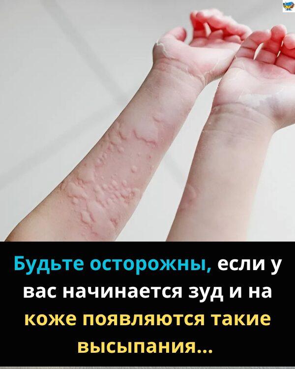 Несподівані причини кропив’янки – що може викликати реакцію шкіри