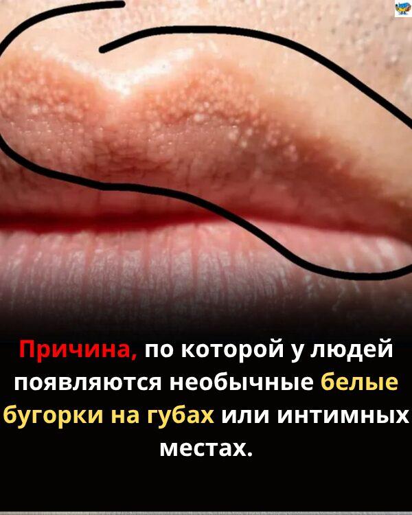 Почему могут появляться необычные белые бугорки на губах или гениталиях Почему могут появляться необычные белые бугорки на губах или гениталиях