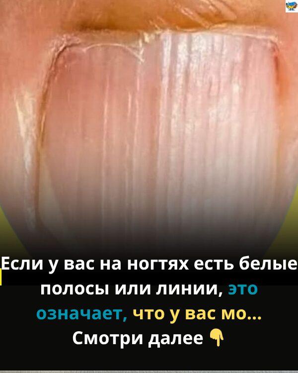 Когда белые линии на ногтях могут быть признаком проблем со здоровьем