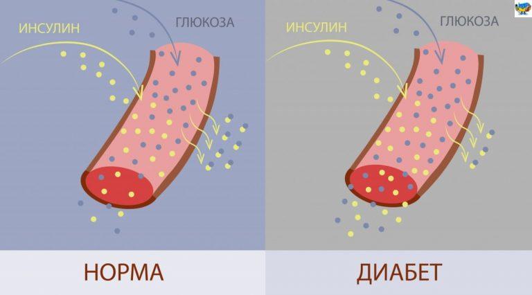 Что делать, если сахар держится 6–7 без лечения